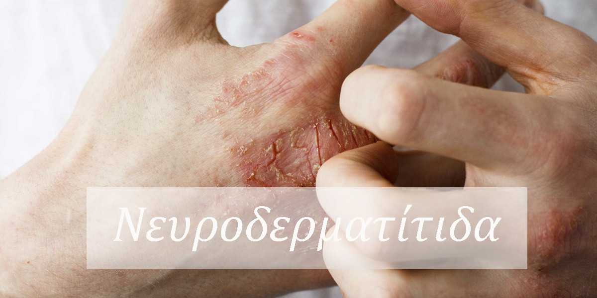 Νευροδερματίτιδα, Τι είναι η νευροδερματίτιδα, Συμπτώματα νευροδερματίτιδας. Αιτίες νευροδερματίτιδας, Στρες, Θεραπεία