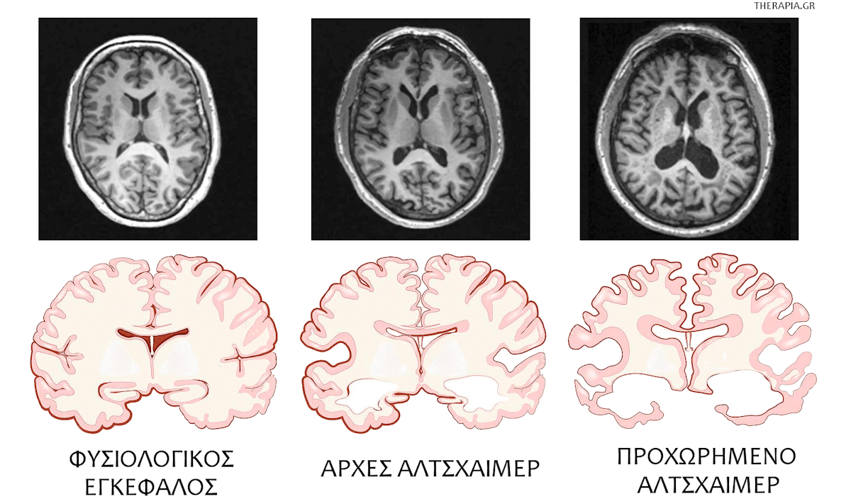 αλτσχαιμερ ανοια alzheimer προσδοκιμο ζωης εξελιξη mri σταδια