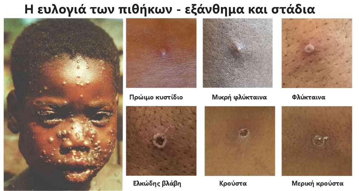 Ευλογιά των πιθήκων, Τι είναι, Εξάνθημα, Στάδια, Κρούσματα, Ελλλάδα, Mpox