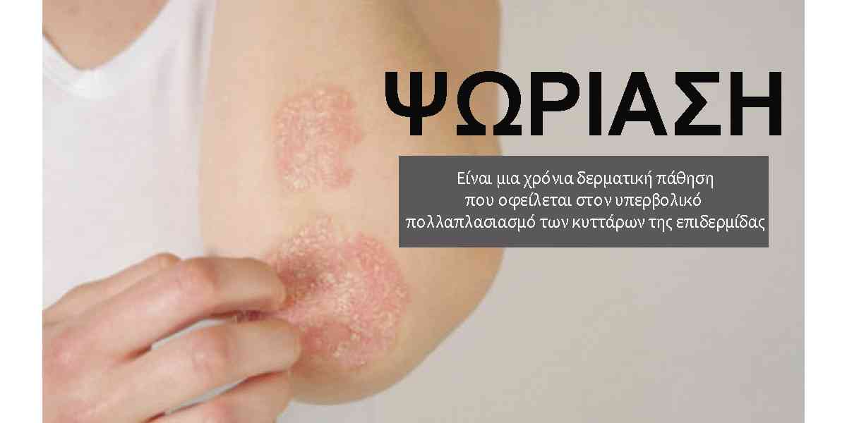 Ψωρίαση, Τι είναι η ψωρίαση, Συμπτώματα ψωρίασης, Τύποι ψωρίασης, Αιτίες ψωρίασης, Θεραπεία ψωρίασης, Παράγοντες που επιδεινώνουν την ψωρίαση, Παράγοντες που προκαλούν έξαρση της ψωρίασης, Ψωρίαση και άγχος, Ψυχοθεραπεία για την ψωρίαση, Ολιστική αντιμετώπιση της ψωρίασης