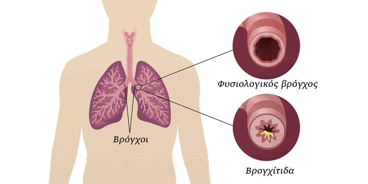 βρογχίτιδα