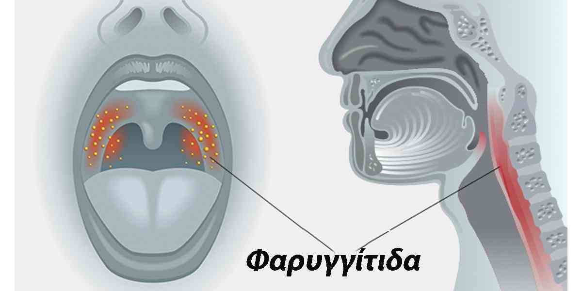 λαρυγγιτιδα η φαρυγγιτιδα