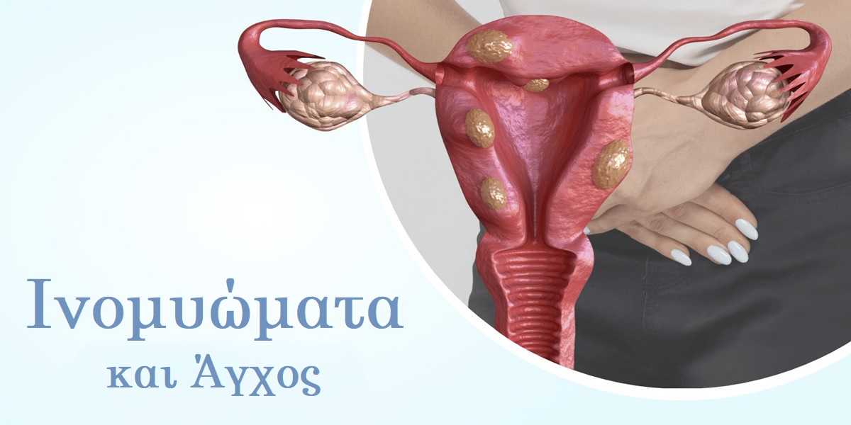 Ινομυώματα και άγχος, Ινομυώματα, Άγχος