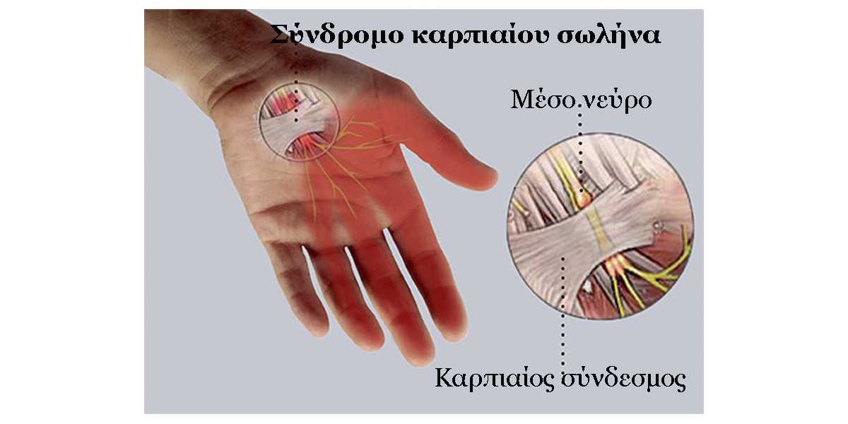 συνδρομο καρπιαιου σωληνα, αντιμετωπιση, θεραπεια