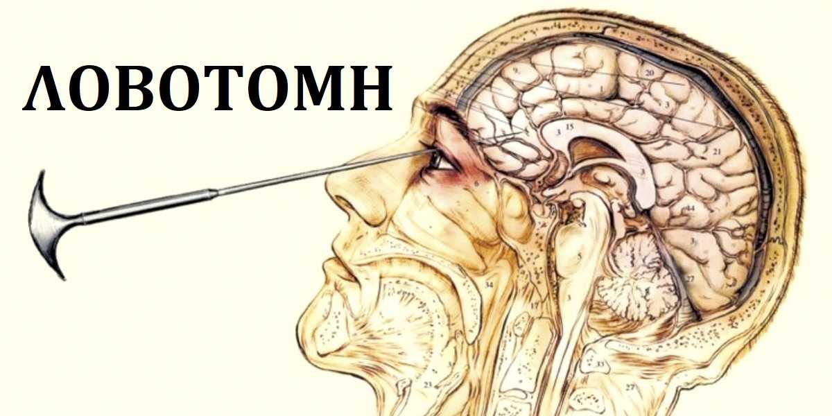 Λοβοτομή, Τι είναι η λοβοτομή, Ιστορία της λοβοτομής, Ανακάλυψη της λοβοτομής