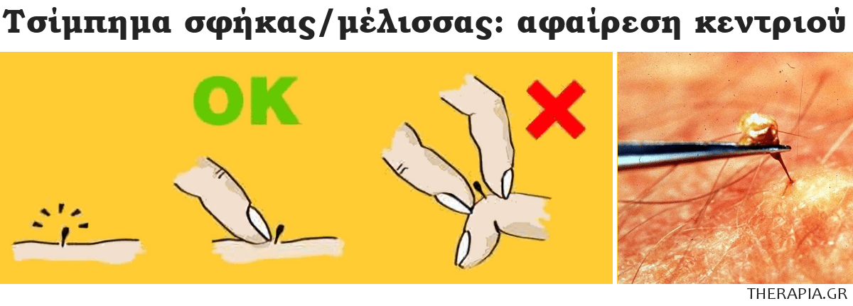 Τσίμπημα σφήκας, Τσίμπημα μέλισσας, Αφαίρεση κεντριού, Αντιμετώπιση, Πρώτες βοήθειες, Πως να βγάλετε το κεντρί