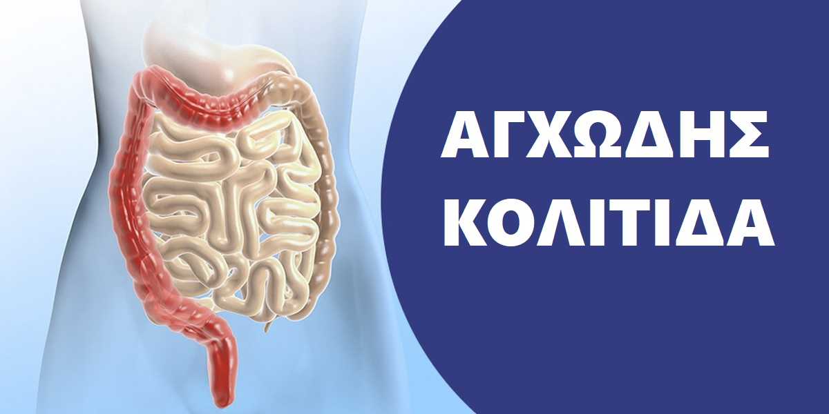 Αγχώδης κολίτιδα, Τι είναι η αγχώδης κολίτιδα, Άγχος και κολίτιδα, Ελκώδης κολίτιδα, Συμπτώματα κολίτιδας, Άγχος και κολίτιδα, Στρες και κολίτιδα, Επίδραση του στρες στην κολίτιδα, Αντιμετώπιση κολίτιδας, Θεραπεία κολίτιδας, Αντιμετώπιση αγχώδους κολίτιδας