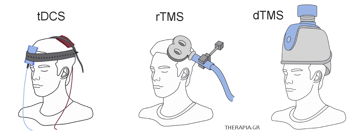 rtms, tms, tdcs, διακρανιακος ηλεκτρικος ερεθισμος, ζαναξ, λαντοζ