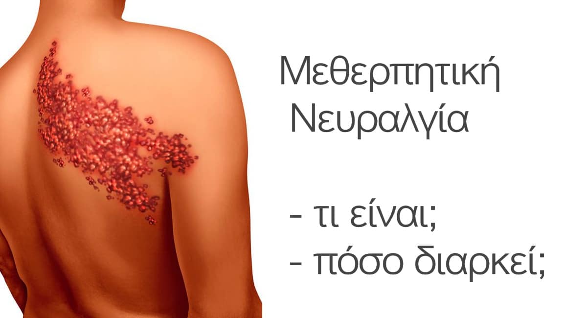 Μεθερπητικη νευραλγία, Τι είναι, Πόσο διαρκεί, Διάρκεια, Χρόνος