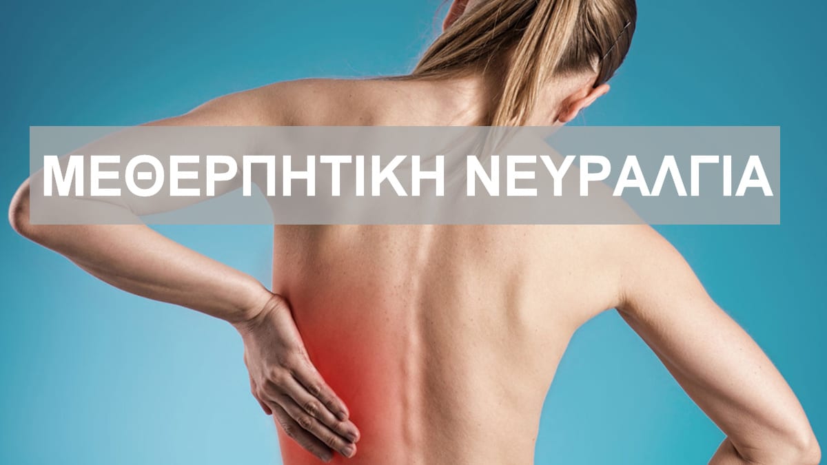 Μεθερπητική νευραλγία, Πόσο διαρκεί, Τι είναι, Αντιμετώπιση, Θεραπεία