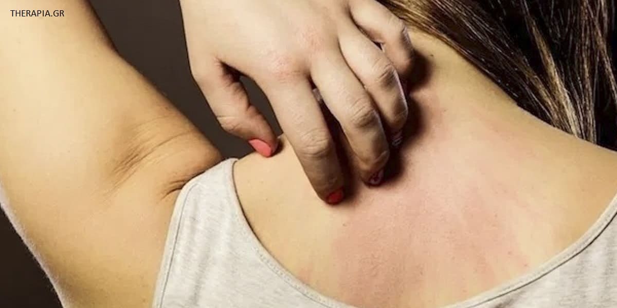 Αγχώδης κνίδωση, Συμπτώματα αγχώδους κνίδωσης, Θεραπεία αγχώδους κνίδωσης