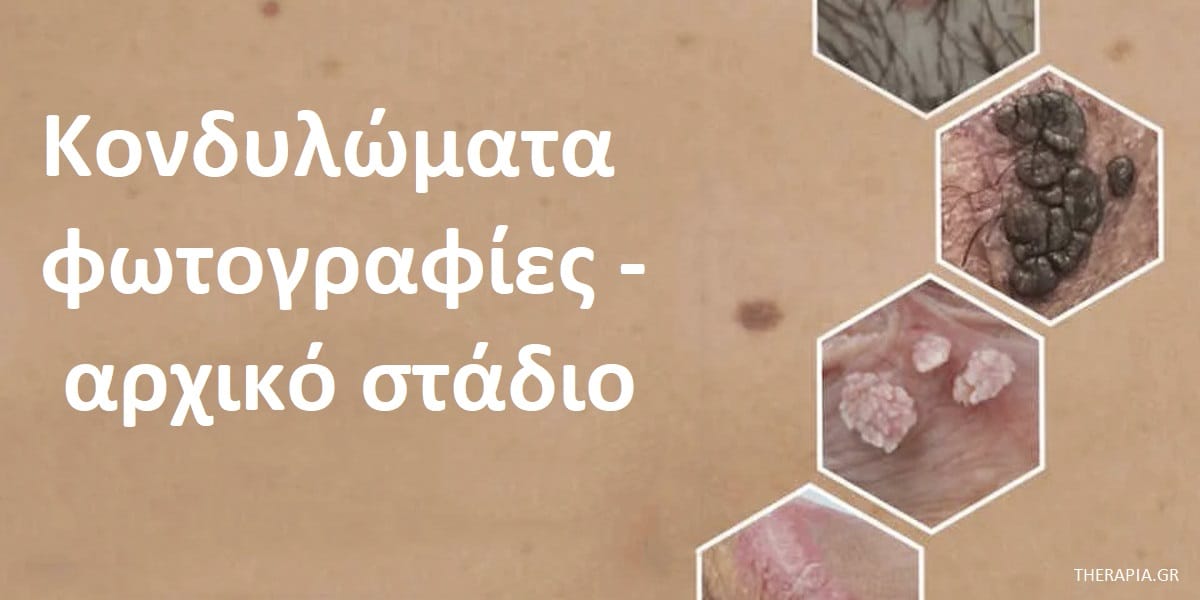 Κονδυλώματα φωτογραφίες αρχικό στάδιο, Κονδυλώματα φωτογραφίες, Κονδυλώματα αρχικό στάδιο, Μετάδοση των κονδυλωμάτων, Αιτίες κονδυλωμάτων, Συμπτώματα κονδυλωμάτων, Διάγνωση κονδυλωμάτων, Θεραπεία κονδυλωμάτων, Επιπλοκές κονδυλωμάτων, Προληπτικά μέτρα για τα κονδυλώματα, Επανεμφάνιση κονδυλωμάτων