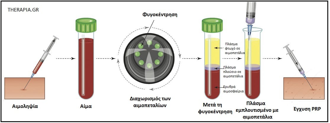 PRP θεραπεία, Πως λειτουργεί η PRP θεραπεία, Χρήσεις PRP θεραπείας