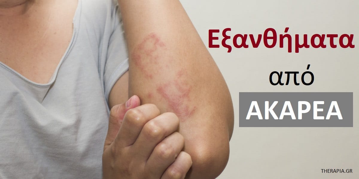 Εξανθήματα από ακάρεα εικόνες, Εξανθήματα από ακάρεα, Συμπτώματα από ακάρεα, Διάγνωση εξανθήματος από ακάρεα, Θεραπεία εξανθήματος από ακάρεα