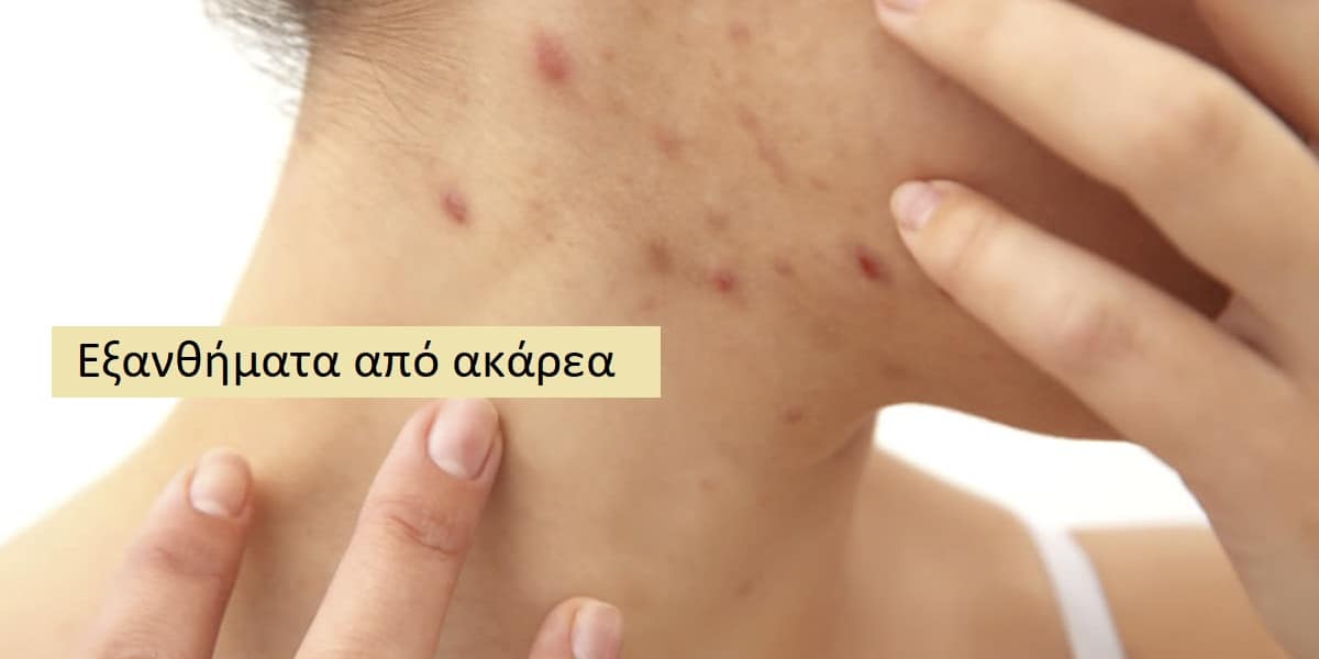 Εξάνθημα από ακάρεα εικόνες, Ακάρεα, Συμπτώματα εξανθήματος από ακάρεα