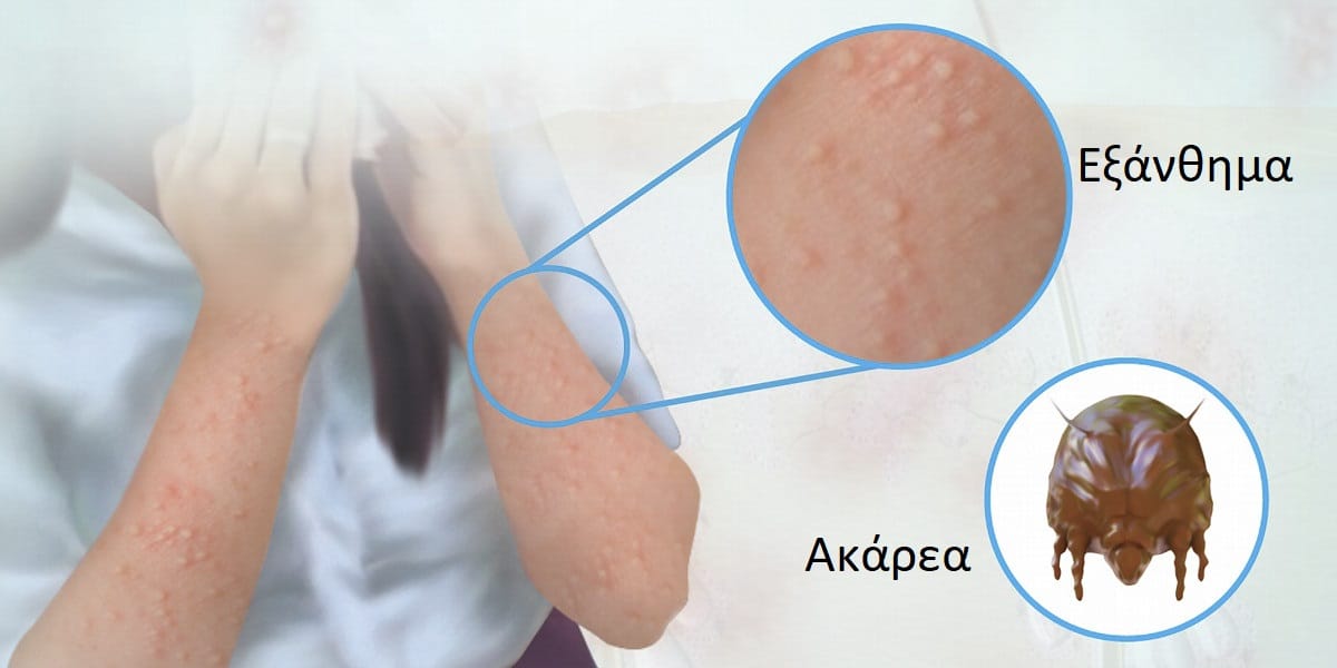 Εξανθήματα από ακάρεα εικόνες, Εξάνθημα από ακάρεα, Ακάρεα