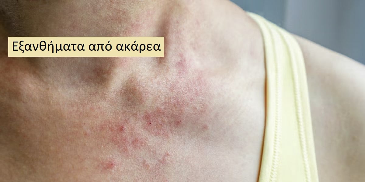 Εξάνθημα από ακάρεα, Ακάρεα, Εικόνες εξανθήματος από ακάρεα