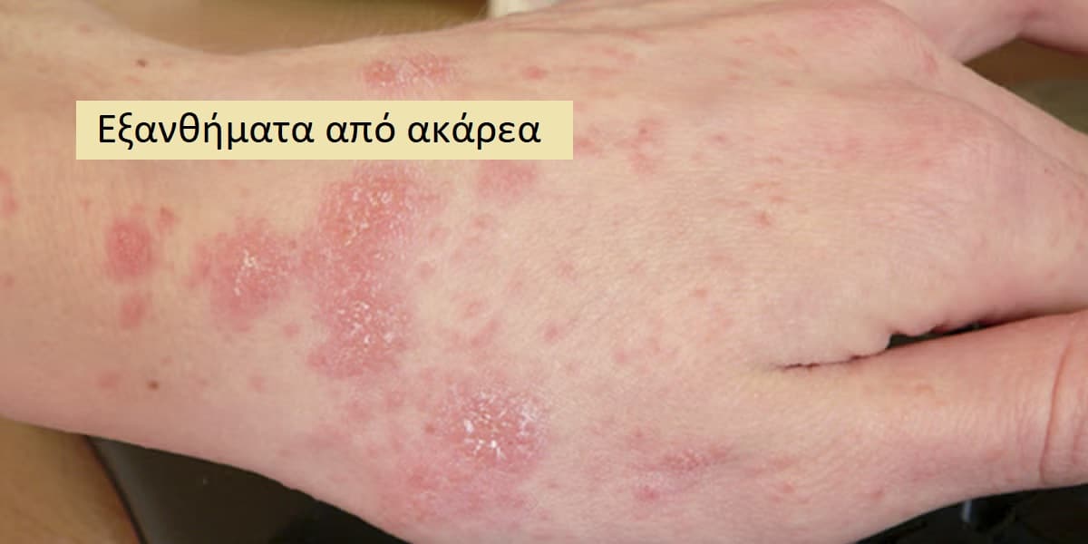 Εξανθήματα από ακάρεα εικόνες, Ακάρεα, Συμπτώματα ακάρεων