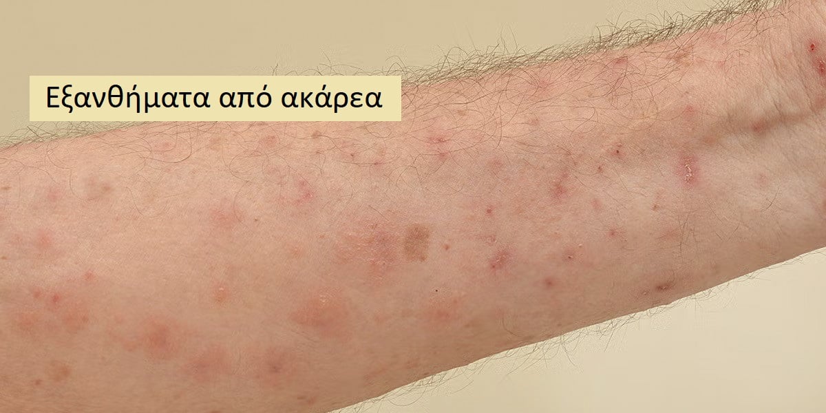 Εξανθήματα από ακάρεα εικόνες, Εξάνθημα από ακάρεα, Ακάρεα