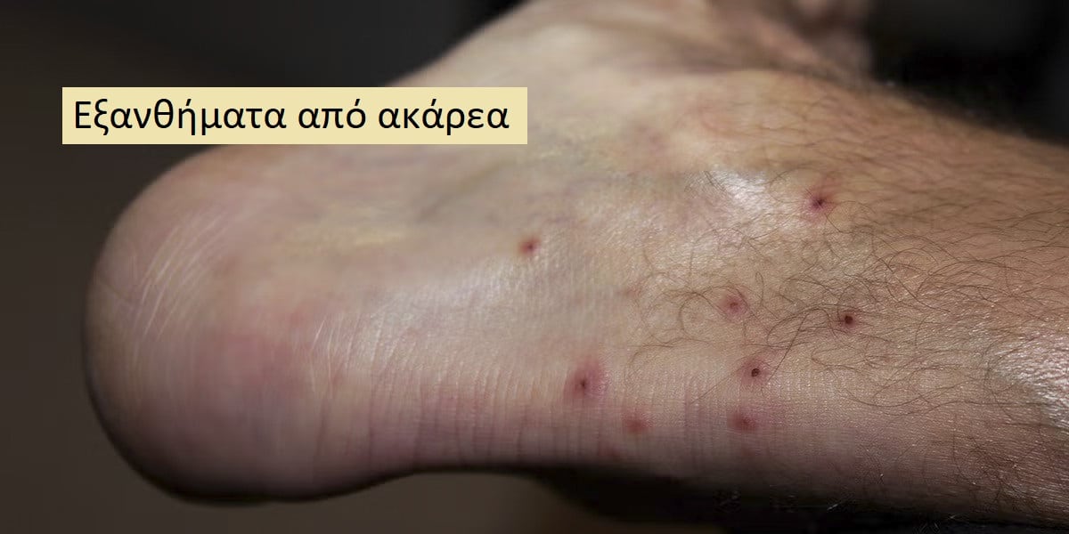 Εξανθήματα από ακάρεα εικόνες, Συμπτώματα ακάρεων, Εξάνθημα από ακάρεα