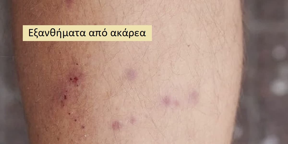 Εξανθήματα από ακάρεα, Συμπτώματα εξανθήματος από ακάρεα, Θεραπεία εξανθήματος από ακάρεα