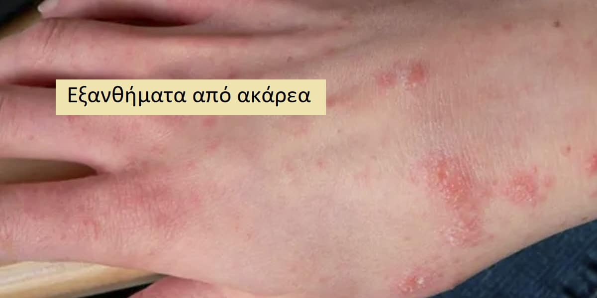 Εξανθήματα από ακάρεα εικόνες, Διάγνωση εξανθήματος από ακάρεα, Θεραπεία εξανθήματος από ακάρεα