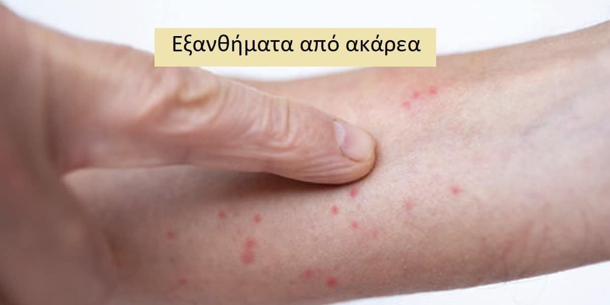 Εξανθήματα από ακάρεα εικόνες, Ακάρεα, Εξάνθημα από ακάρεα