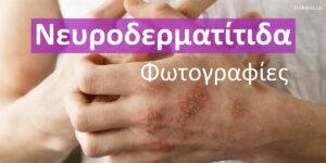 Νευροδερματίτιδα – φωτογραφίες