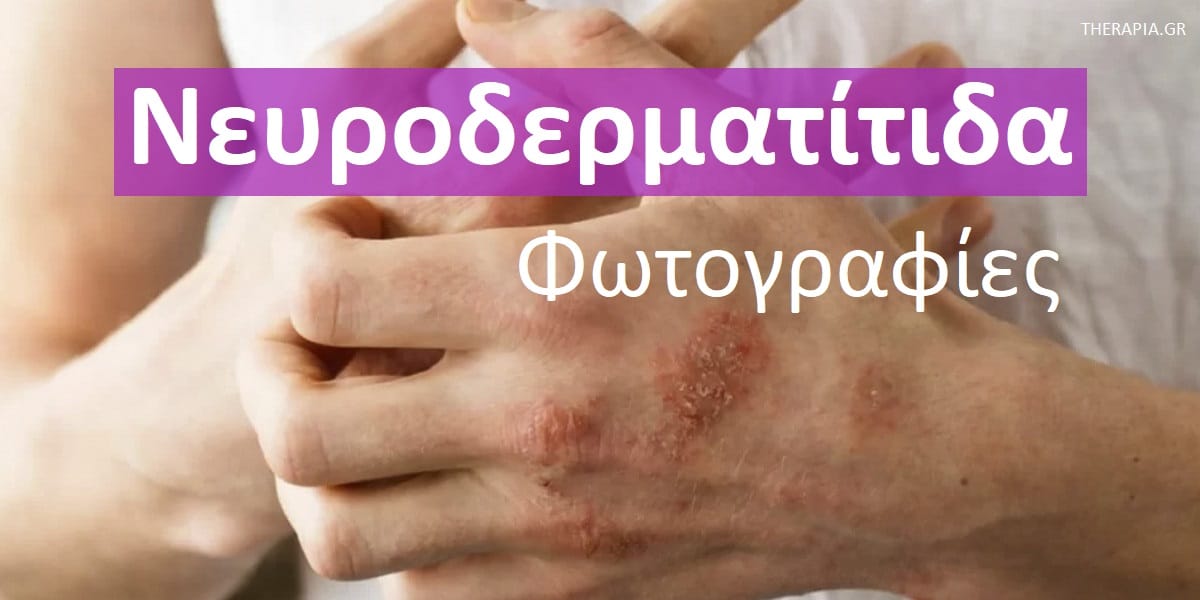 Νευροδερματίτιδα , Νευροδερματίτιδα φωτογραφίες, Νευροδερματίτιδα εικόνες Συμπτώματα νευροδερματίτιδας, Αιτίες νευροδερματίτιδας, Θεραπεία νευροδερματίτιδας