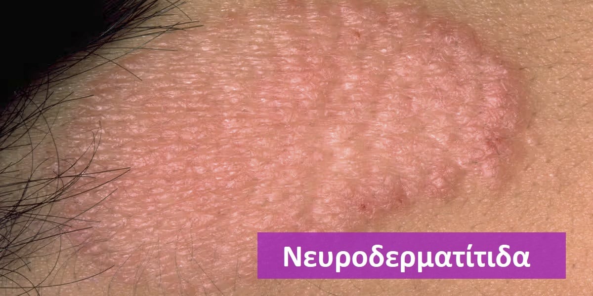 Νευροδερματίτιδα, Νευροδερματίτιδα εικόνες, Νευροδερματίτιδα φωτογραφίες