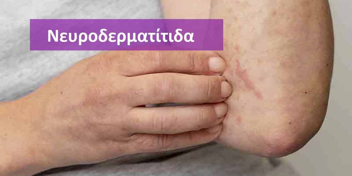 Νευροδερματίτιδα, Νευροδερματίτιδα εικόνες, Νευροδερματίτιδα φωτογραφίες