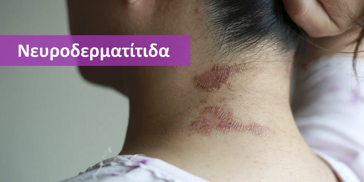 Νευροδερματίτιδα, Νευροδερματίτιδα εικόνες, Νευροδερματίτιδα φωτογραφίες