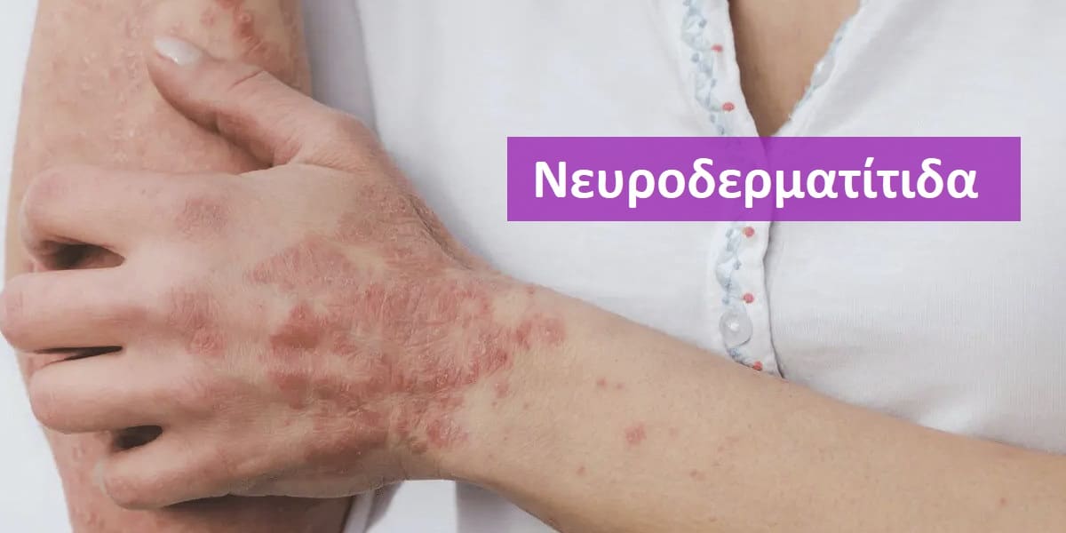 Νευροδερματίτιδα, Νευροδερματίτιδα εικόνες, Νευροδερματίτιδα φωτογραφίες