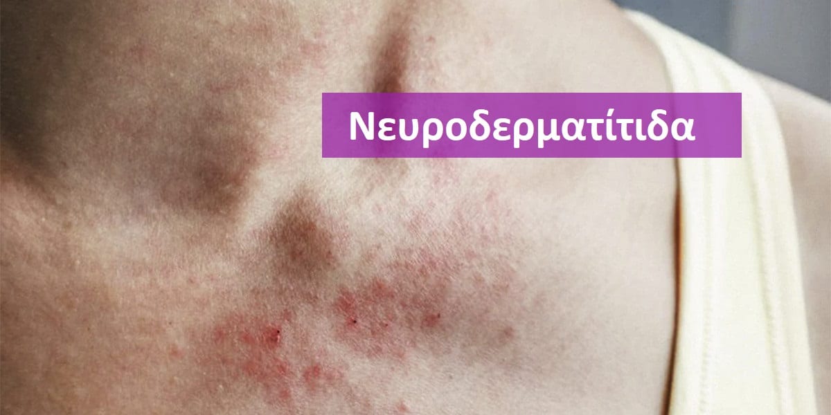 Νευροδερματίτιδα, Νευροδερματίτιδα εικόνες, Νευροδερματίτιδα φωτογραφίες