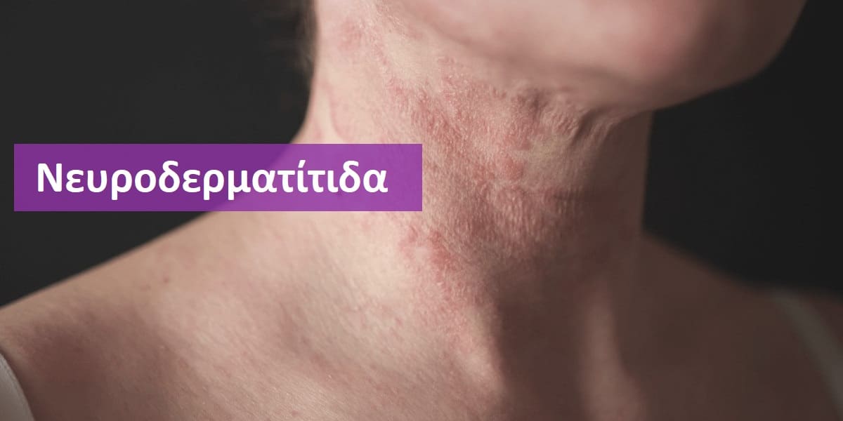 Νευροδερματίτιδα, Νευροδερματίτιδα εικόνες, Νευροδερματίτιδα φωτογραφίες