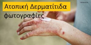 Ατοπική δερματίτιδα-φωτογραφίες