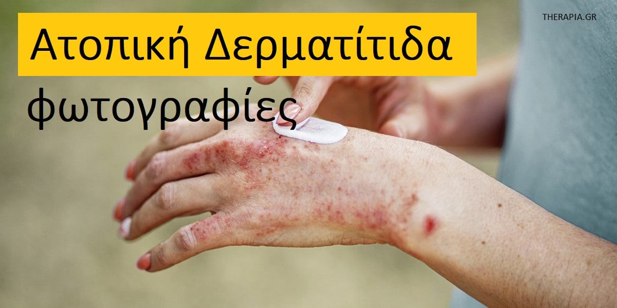 Ατοπική δερματίτιδα φωτογραφίες, Ατοπική δερματίτιδα, Συμπτώματα ατοπικής δερματίτιδας, Αιτίες ατοπικής δερματίτιδας, Διάγνωση ατοπικής δερματίτιδας, Θεραπεία ατοπικής δερματίτιδας