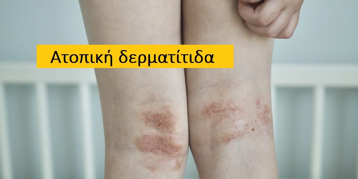 Ατοπική δερματίτιδα φωτογραφίες, Ατοπική δερματίτιδα συμπτώματα, Ατοπική δερματίτιδα αιτίες