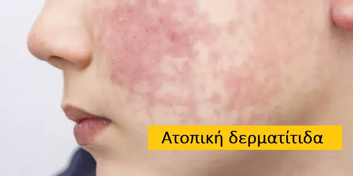 Ατοπική δερματίτιδα φωτογραφίες, Ατοπική δερματίτιδα διάγνωση, Ατοπική δερματίτιδα θεραπεία