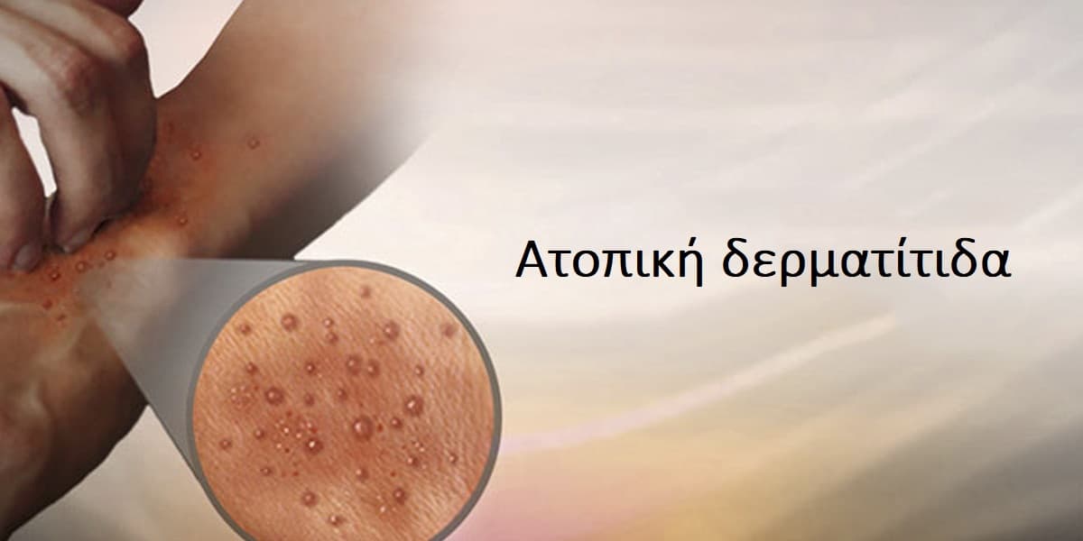 Ατοπική δερματίτιδα, Συμπτώματα ατοπικής δερματίτιδας, Αιτίες ατοπικής δερματίτιδας