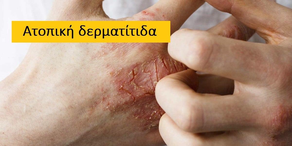 Ατοπική δερματίτιδα, Διάγνωση ατοπικής δερματίτιδας, Θεραπεία ατοπικής δερματίτιδας