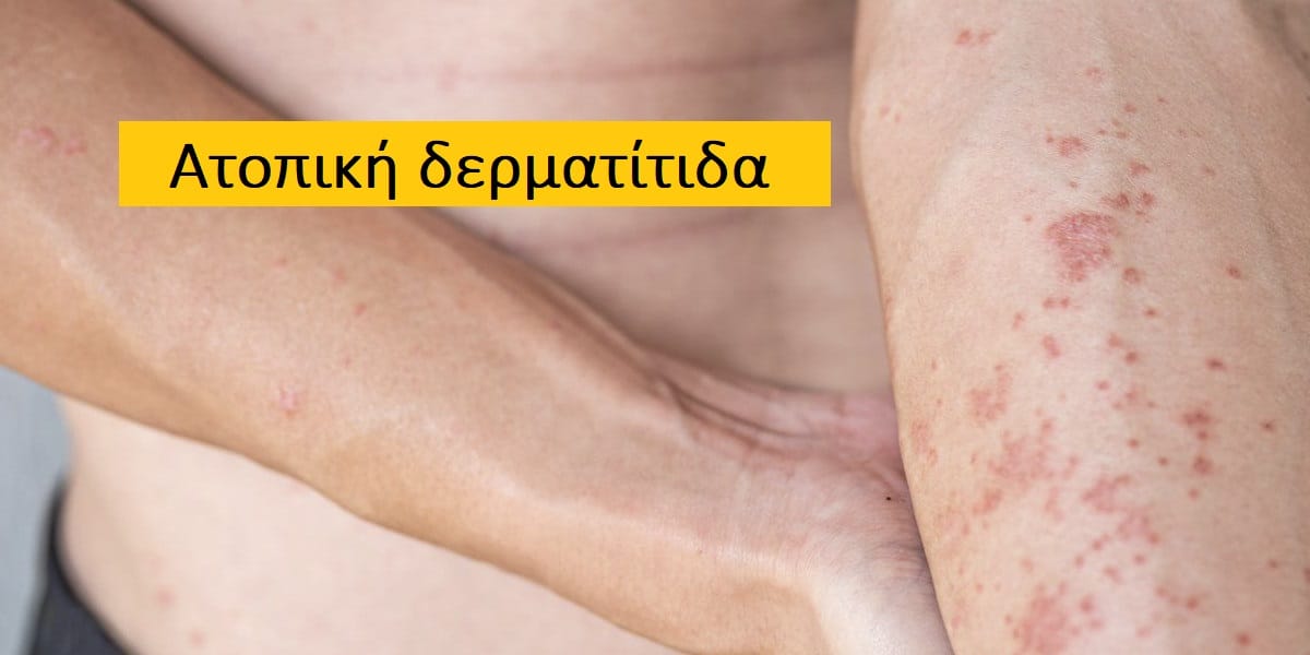 Ατοπική δερματίτιδα φωτογραφίες, Εικόνες ατοπικής δερματίτιδας, Συμπτώματα ατοπικής δερματίτιδας