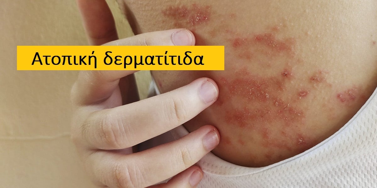 Ατοπική δερματίτιδα φωτογραφίες, Θεραπεία ατοπικής δερματίτιδας, Εικόνες ατοπικής δερματίτιδας