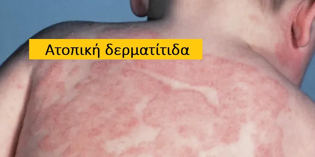 Ατοπική δερματίτιδα, Συμπτώματα ατοπικής δερματίτιδας, Αιτίες ατοπικής δερματίτιδας