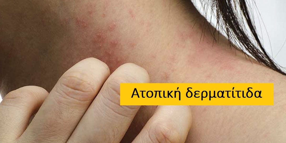 Ατοπική δερματίτιδα, Συμπτώματα ατοπικής δερματίτιδας, Θεραπεία ατοπικής δερματίτιδας