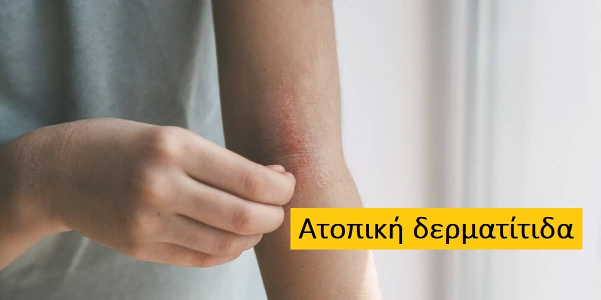 Ατοπική δερματίτιδα φωτογραφίες, Ατοπική δερματίτιδα εικόνες, Ατοπική δερματίτιδα συμπτώματα