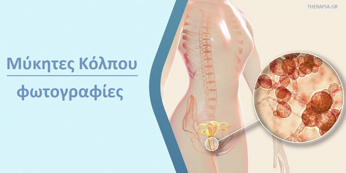 Μύκητες κόλπου φωτογραφίες, Μύκητες κόλπου συμπτώματα, Μύκητες κόλπου αιτίες, Μύκητες κόλπου διάγνωση, Μύκητες κόλπου θεραπεία, Μύκητες κόλπου αντιμετώπιση, Μύκητες κόλπου εικόνες