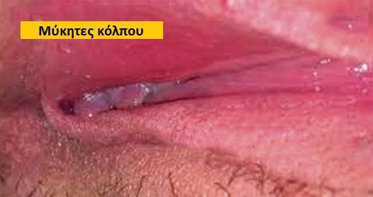 Μύκητες κόλπου φωτογραφίες, Μύκητες κόλπου εικόνες, Μύκητες κόλπου