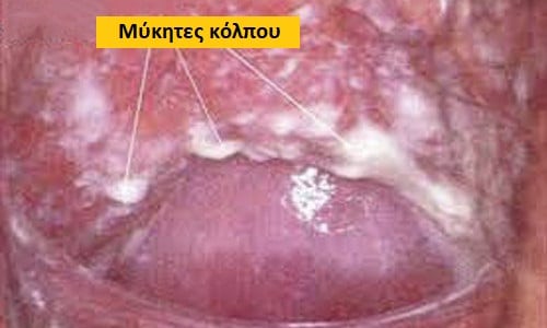 Μύκητες κόλπου φωτογραφίες, Μύκητες κόλπου, Μύκητες κόλπου θεραπεία