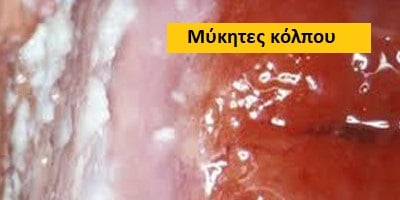 Μύκητες κόλπου εικόνες, Μύκητες κόλπου, Μύκητες κόλπου θεραπεία